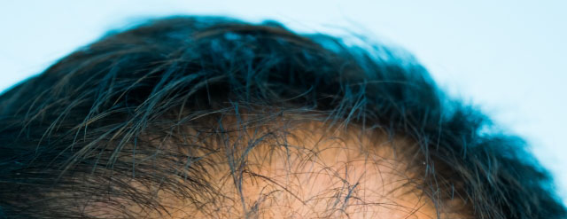 男性型脱毛症の予防改善